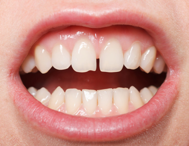 diastema.jpg